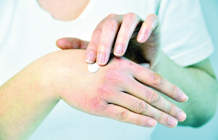 طرق علاج جفاف الأيدي من آثار المنظفات